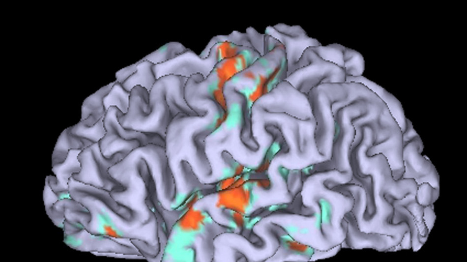  Emicrania, fotografata la neuroinfiammazione del nervo del dolore 