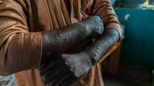 Mpox: un premier cas du nouveau variant identifi&eacute; en France