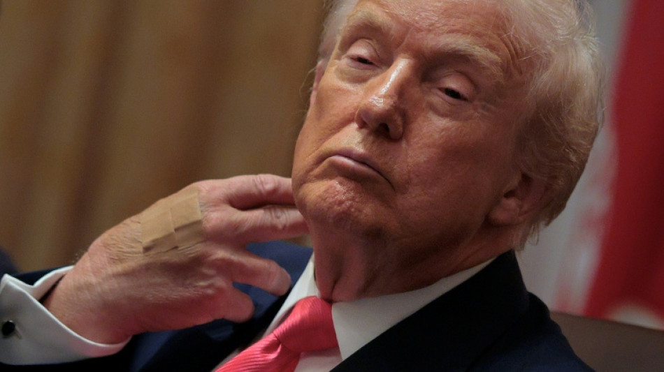 Trump blames bruised hand on aspirin, denies falling asleep